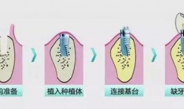 爆料种植牙套路视频大全,视频大全揭示行业潜规则
